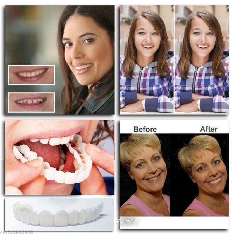 Comfortable Custom Fit Dental Plates