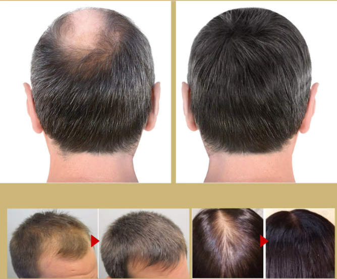 Thicker Fuller Hair Vitamins Supplements