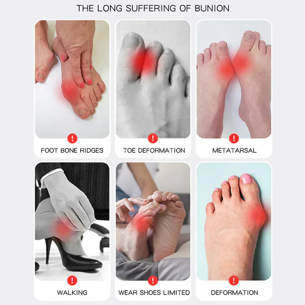 Orthopedic Shoe Insoles for Hallux Valgus Pain Relief
