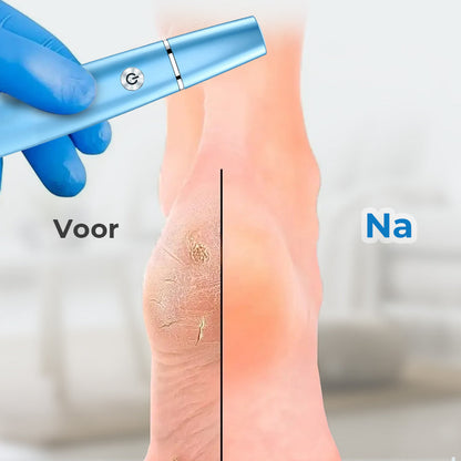 SoftFeet Exfoliator for Smooth Feet