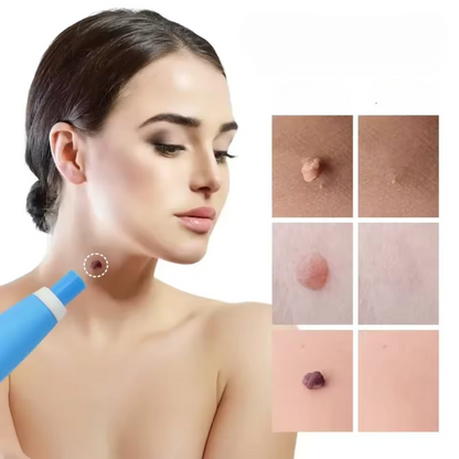 Fast Wart Removal Cream - Befez