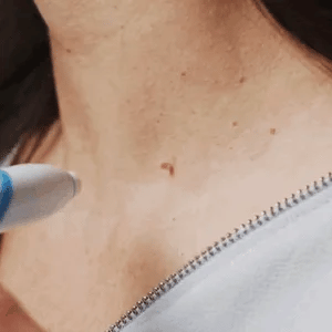 Easy Hair Removal Device for Smooth Skin