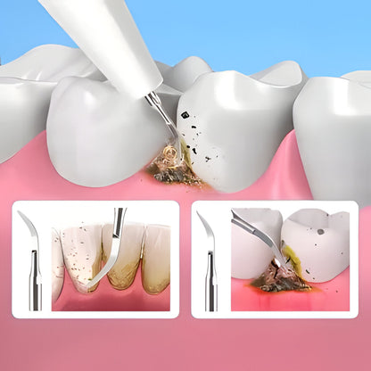 Professional Dental Scaler Tool
