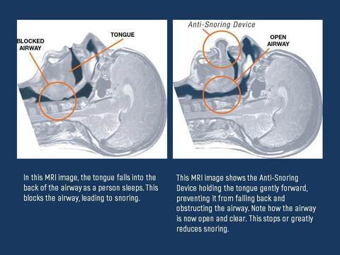 Anti Snore Tongue Stabilizer Device