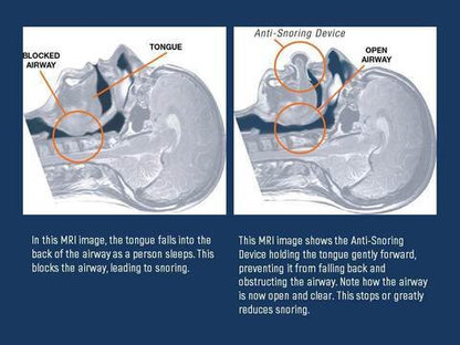 Anti Snore Tongue Stabilizer Device