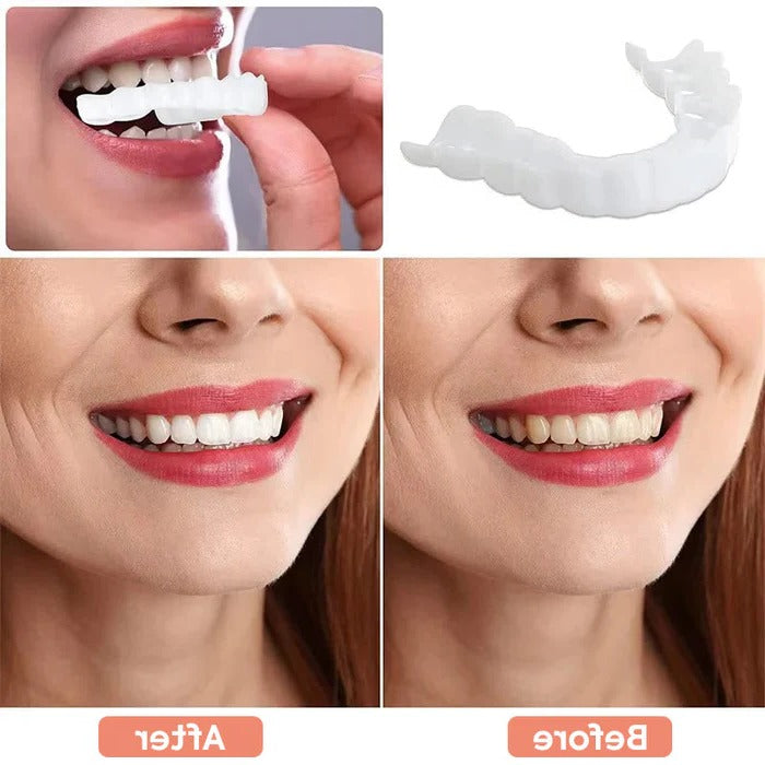 Realistic Smile Dental Veneers with Bright Finish
