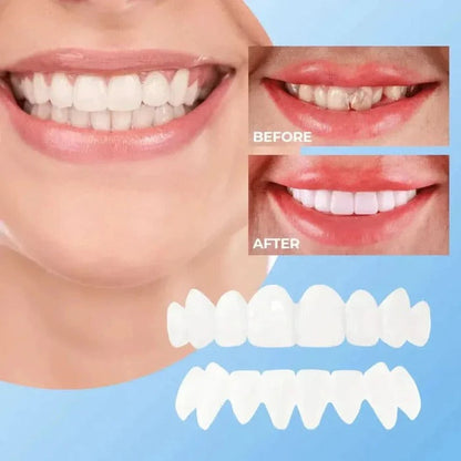 Realistic Smile Dental Veneers with Bright Finish